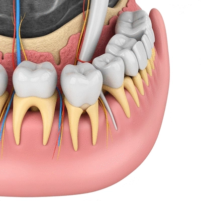 Detailed anatomical diagram showing an impacted wisdom tooth within a jawbone
